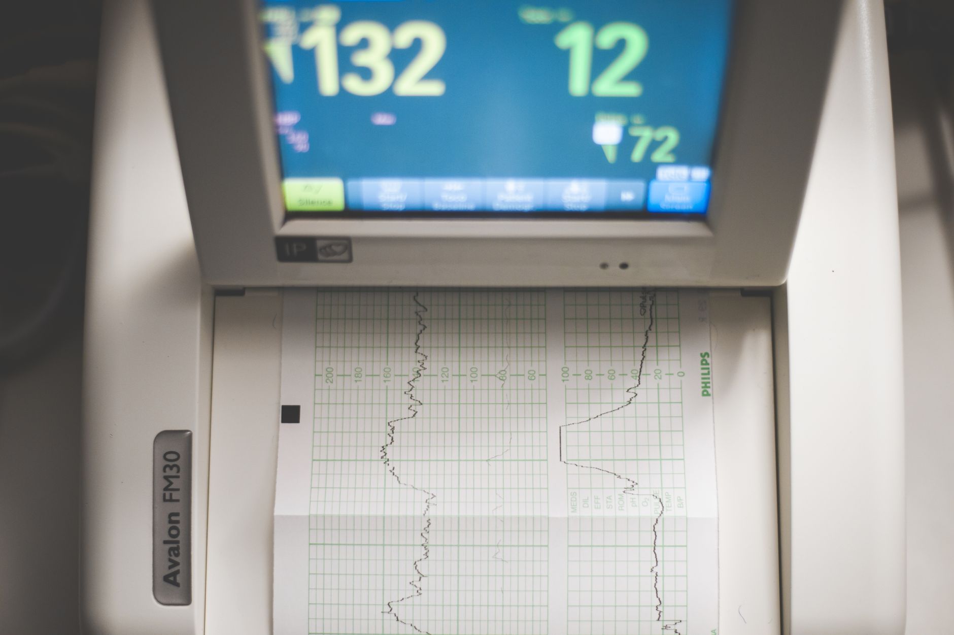 Cardiac monitor showing an ECG tracing used to detect potassium-related arrhythmias
